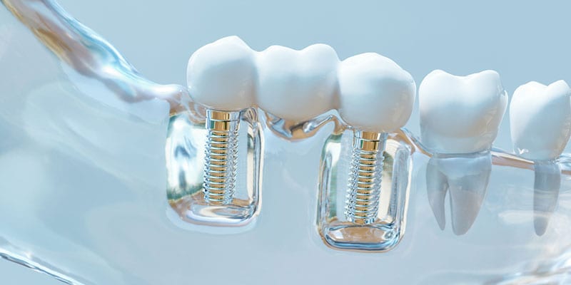 Repair Your Smile with Dental Implants