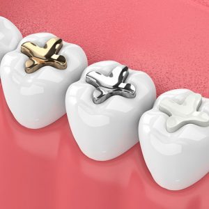 Why You Need Dental Fillings for Cavities