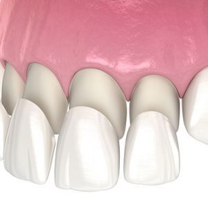 Intro to Dental Veneers