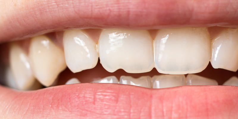 What are the Most Common Dental Problems?